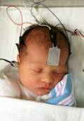 Figure A: an infant during an ABR procedure, a testing instrument on the forehead