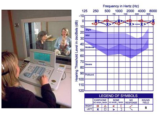 Figure F: an infant during behavioral Audiological testing and a typical audiogram