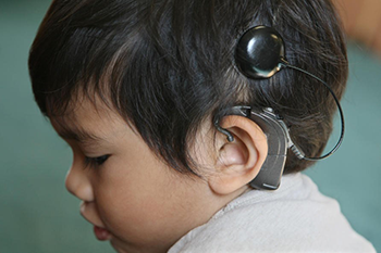 A child with a cochlear implant